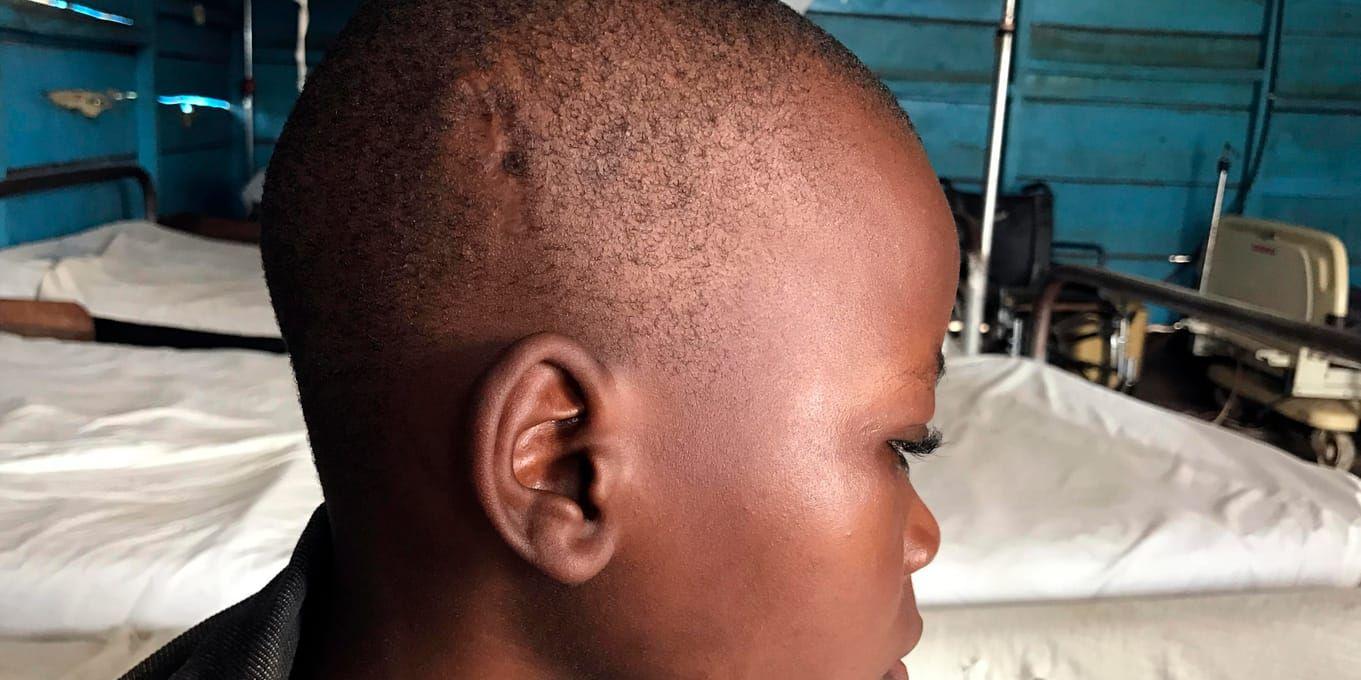 En pojke som fallit offer för oroligheterna i Kasai-regionen i Kongo-Kinshasa visar upp ett ärr. Hundratusentals barn riskerar att svälta ihjäl i regionen om de inte får tillgång till nödhjälp, enligt FN. Arkivbild.