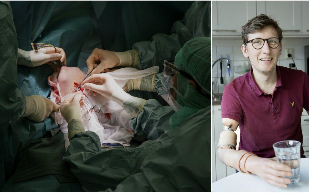 Ulf Karlsson som fått ny armprotes inopererad av CARE på Sahlgenska. Foto: Marie Ullnert/Sahlgrenska Universitetssjukhuset.