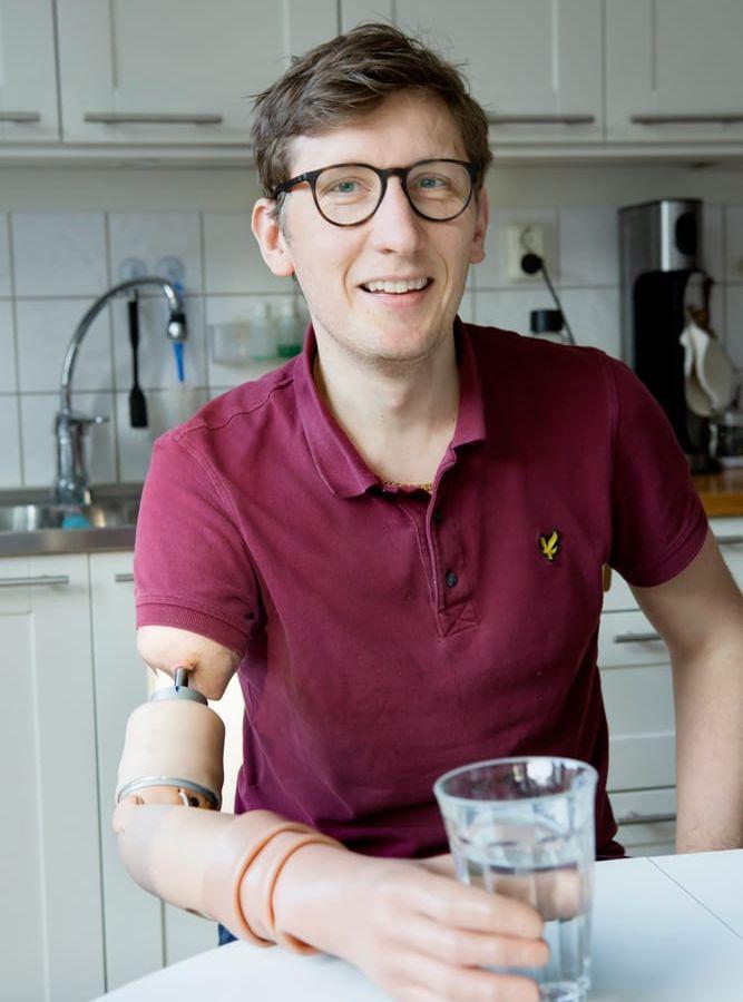 Nu har han, tack vare en robotarm som tidigare använts av enbart tre personer i hela världen, fått tillbaka sin arm. Foto: Marie Ullnert/Sahlgrenska Universitetssjukhuset.