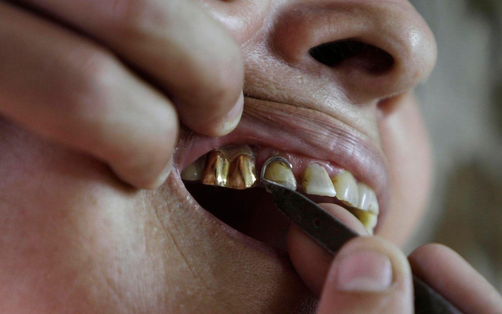 Nästan alla människor sägs ha guldtänder. Detta för att guld kan formas precis som tänder och har därför använts som restauration. Bild: TT