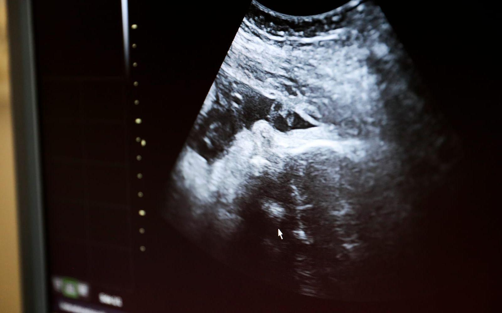 Flera regioner ska fasa ut fosterdiagnostiktestet kub. Arkivbild. 