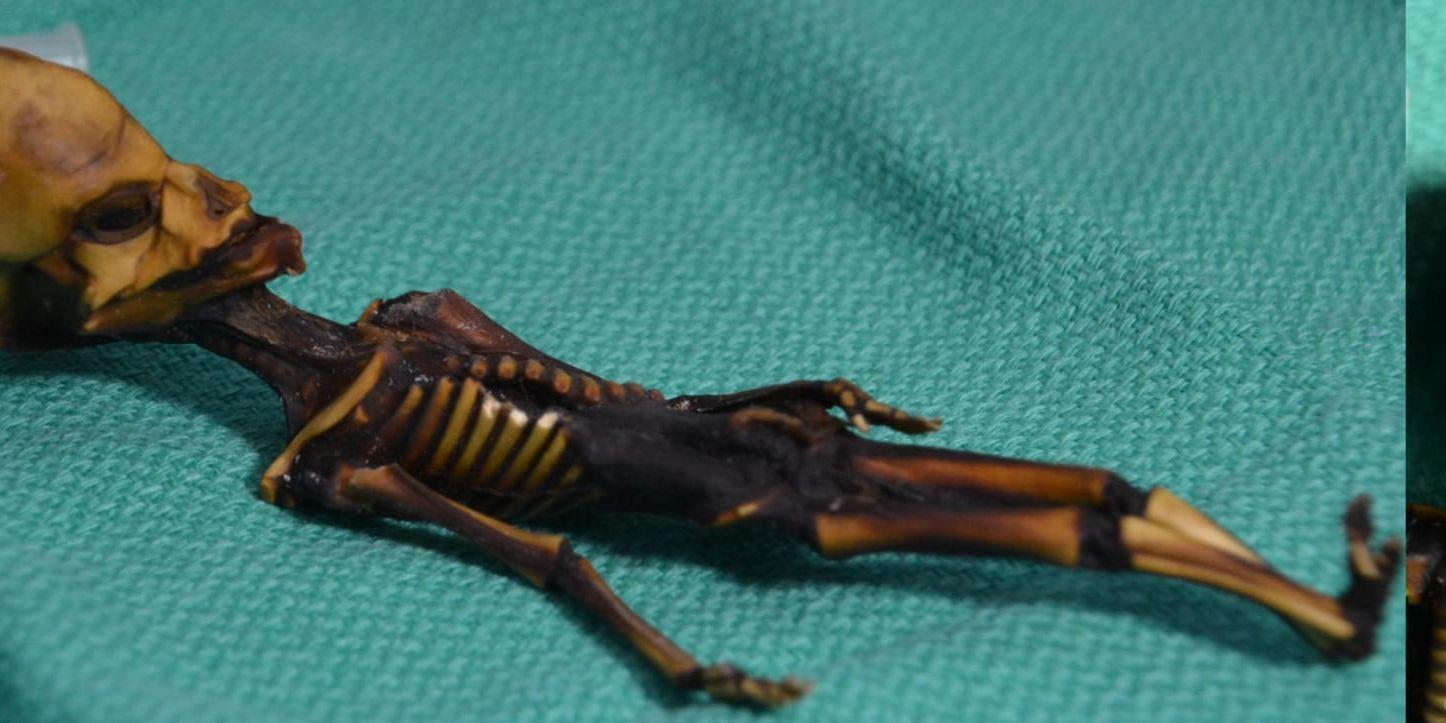 Det utomjordingliknande skelettet från Atacamöknen i Chile tillhörde ett litet flickfoster med sällsynta genmutationer kopplade till dvärgväxt och förtida åldrande, visar analysen från universitetet i Stanford.
