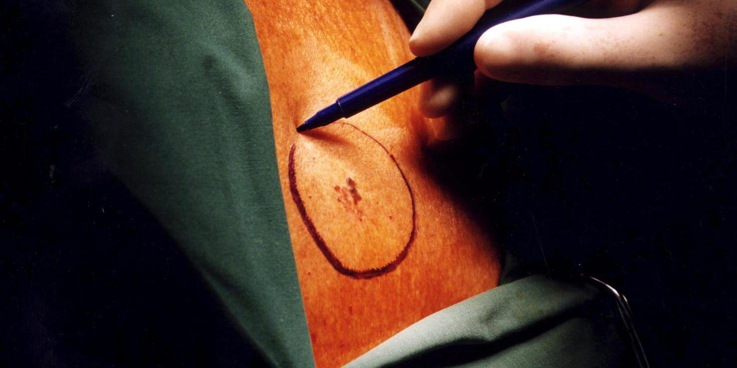 En hand med penna markerar med en ring runt en förändring på huden. Arkivbild.