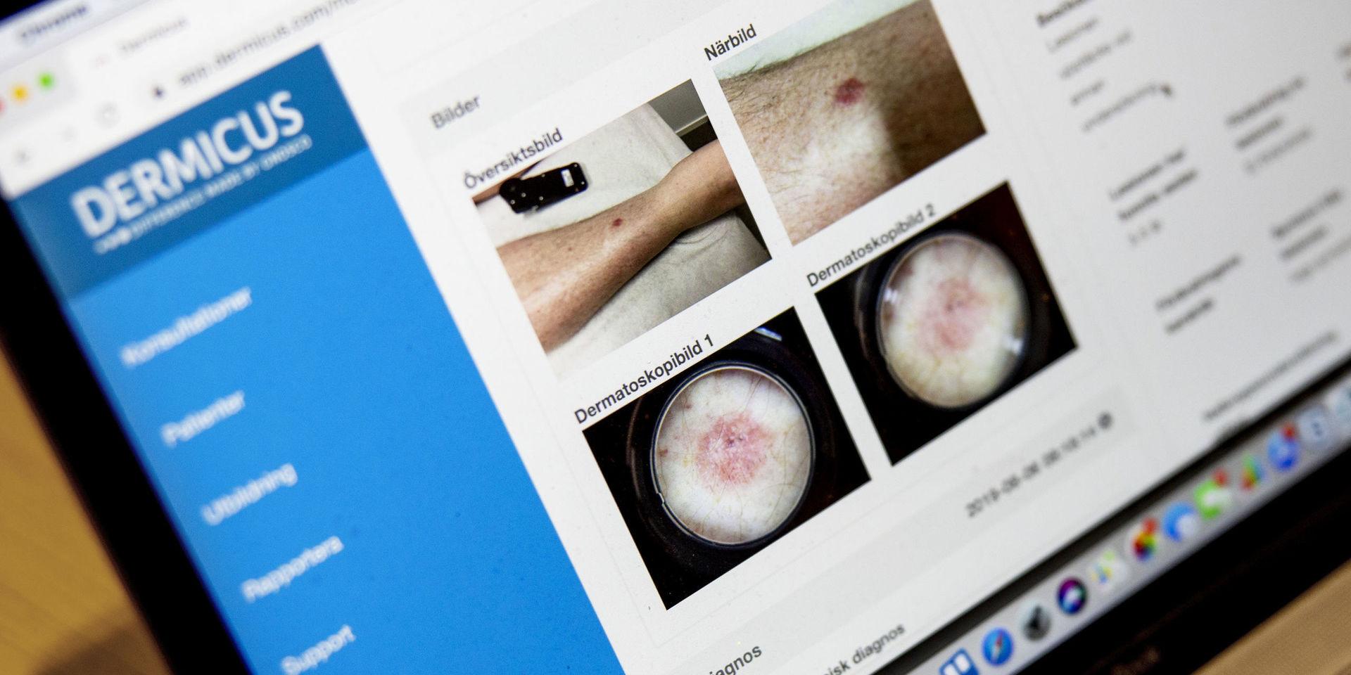 Med en mobilapp kan vårdcentralerna skicka iväg bilder på hudförändringar till hudspecialister. Metoden gör, enligt utvecklarna, att det går snabbare att ställa en diagnos på hudcancerpatienter. 