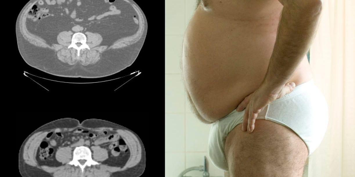 Den övre röntgenbilden visar buken på en person med fetmasjukdom. Den undre bilden är ett exempel på en normalviktig person.