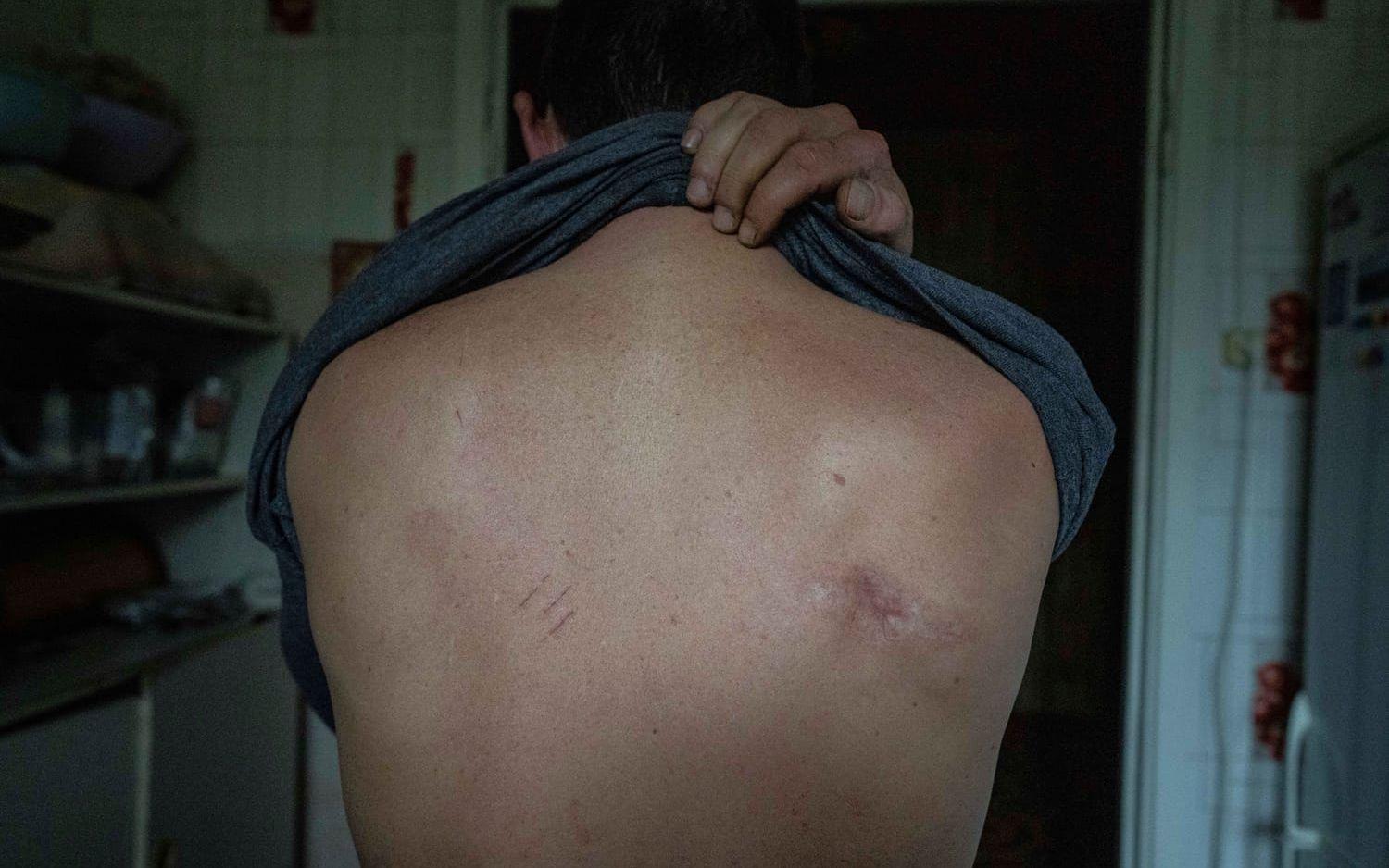 Mykola Mosyakyn visar upp sin ärrade rygg. Mosyakyn uppger att han torterats av ryska soldater i ukrainska Izium, som befriades från rysk ockupation i september.